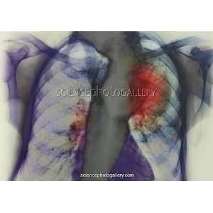 Lung cancer X ray Framed Prints