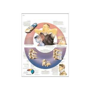 3B Scientific VR3761UU Glossy Paper Síndrome Cervical Postraumatico 
