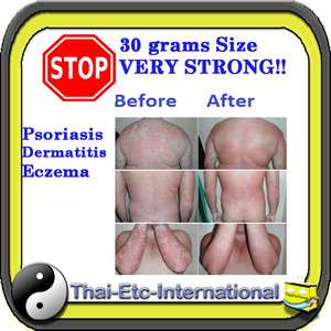 30g STRONG CREAM ITCHING ECZEMA PSORIASIS DERMATITIS REDUCE SWELLING 